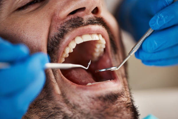 Best Wisdom Tooth Removal  in Lake Goodwin, WA