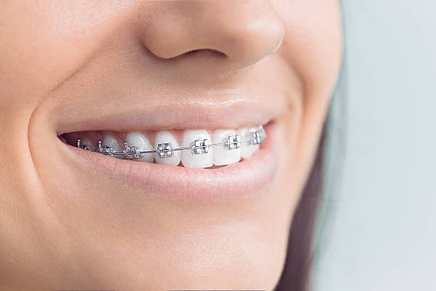 Best Traditional Braces  in Lake Goodwin, WA